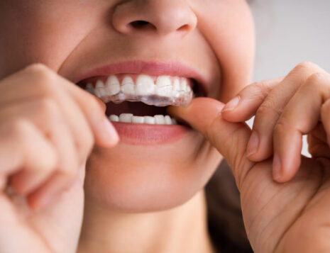 Are clear aligners worth it?