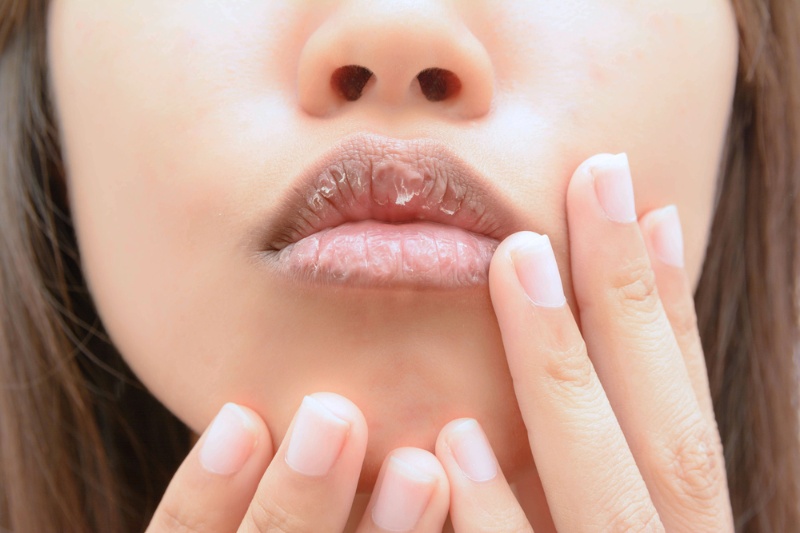dry mouth